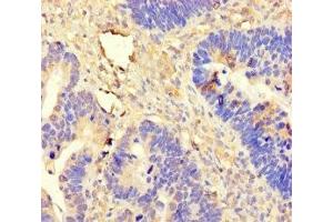 Immunohistochemistry of paraffin-embedded human ovarian cancer using ABIN7144980 at dilution of 1:100 (DDX19A 抗体  (AA 1-478))