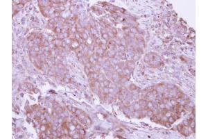 IHC-P Image Immunohistochemical analysis of paraffin-embedded human breast cancer, using CD27, antibody at 1:250 dilution. (CD27 抗体)