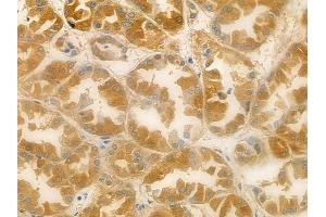 ABIN6257922 and ABIN6274886 at 1/100 staining human renal cell carcinoma by IHC-P. (ABCF1 抗体  (C-Term))