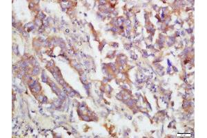 Formalin-fixed and paraffin embedded human lung carcinoma labeled with Rabbit Anti-MKK3(Ser218)/MKK6(Ser207) Polyclonal Antibody, Unconjugated  at 1:200 followed by conjugation to the secondary antibody and DAB staining (MAP2K3 抗体  (pSer207))