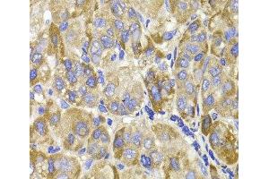 Immunohistochemistry of paraffin-embedded Human liver cancer using MAGED1 Polyclonal Antibody at dilution of 1:100 (40x lens). (MAGED1 抗体)