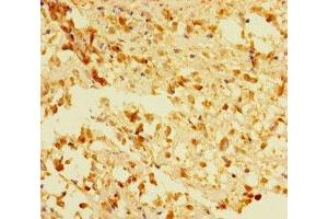 Immunohistochemistry of paraffin-embedded human melanoma using ABIN7166648 at dilution of 1:100 (ACOT6 抗体  (AA 1-207))