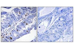 Immunohistochemical analysis of paraffin-embedded human colon carcinoma tissue using Nuclear Receptor NR4A1 (Phospho-Ser351) antibody (left)or the same antibody preincubated with blocking peptide (right).