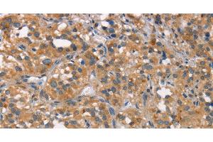 Immunohistochemistry of paraffin-embedded Human thyroid cancer tissue using CEACAM6 Polyclonal Antibody at dilution 1:50