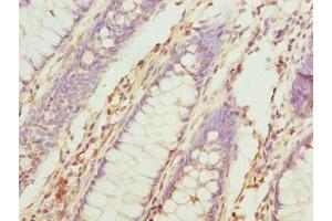 Immunohistochemistry of paraffin-embedded human colon cancer using ABIN7173695 at dilution of 1:100 (TUBb6 抗体  (AA 1-446))