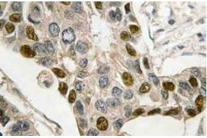 Immunohistochemistry (IHC) analyzes of c-Myb antibody in paraffin-embedded human breast carcinoma tissue. (MYB 抗体)