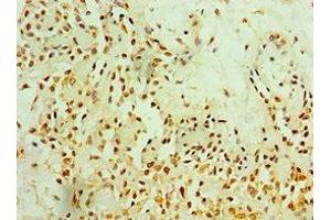 Immunohistochemistry of paraffin-embedded human breast cancer using ABIN7165774 at dilution of 1:100 (MTDH 抗体  (AA 1-260))
