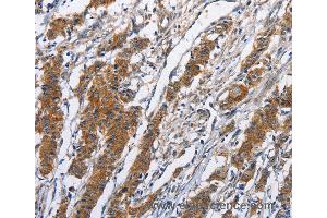 Immunohistochemistry of Human thyroid cancer using NCAPD3 Polyclonal Antibody at dilution of 1:50 (NCAPD3 抗体)