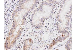 IHC-P Image Immunohistochemical analysis of paraffin-embedded human gastric cancer, using DLD, antibody at 1:100 dilution. (DLD 抗体)