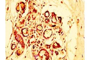 IHC image of ABIN7162334 diluted at 1:300 and staining in paraffin-embedded human breast cancer performed on a Leica BondTM system. (OTUD5 抗体  (AA 51-183))