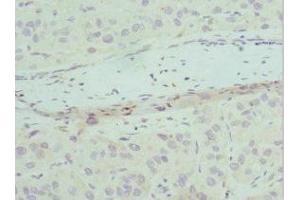 Immunohistochemistry of paraffin-embedded human liver cancer using ABIN7147523 at dilution of 1:100 (CHMP2B 抗体  (AA 1-213))