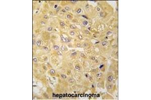 Formalin-fixed and paraffin-embedded human hepatocarcinoma tissue reacted with ILK1/ILK2 Antibody (N-term) (ABIN391993 and ABIN2841781) , which was peroxidase-conjugated to the secondary antibody, followed by DAB staining. (ILK 抗体  (N-Term))