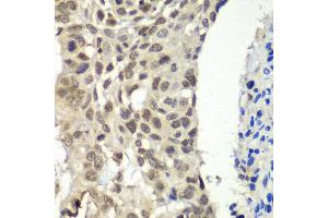 Immunohistochemistry of paraffin-embedded human esophageal cancer using SSRP1 antibody at dilution of 1:100 (x40 lens). (SSRP1 抗体)