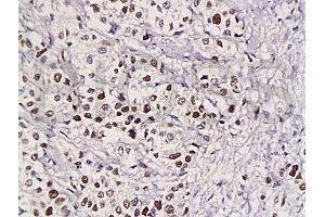 Formalin-fixed and paraffin embedded human gastric carcinoma with Anti-Pokemon Polyclonal Antibody, Unconjugated (ABIN729448) at 1:200, followed by conjugation to the secondary antibody and DAB staining (ZBTB7A 抗体  (AA 151-250))