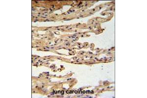 FKBPL Antibody IHC analysis in formalin fixed and paraffin embedded lung carcinoma followed by peroxidase conjugation of the secondary antibody and DAB staining. (FKBPL 抗体  (C-Term))