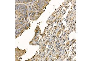Immunohistochemistry of paraffin-embedded human colon carcinoma using GSDMD (Full Length+N terminal) Rabbit pAb  at dilution of 1:100 (40x lens). (GSDMD 抗体)