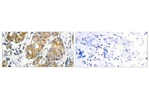 Immunohistochemical analysis of paraffin- embedded human breast carcinoma tissue using GSK3α (Ab-21) antibody (E021007). (GSK3 alpha 抗体)