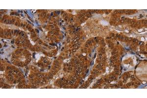 Immunohistochemistry of paraffin-embedded Human thyroid cancer tissue using WDR83 Polyclonal Antibody at dilution 1:60 (MORG1 抗体)