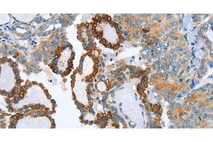 Immunohistochemistry of paraffin-embedded Human thyroid cancer tissue using AIP Polyclonal Antibody at dilution 1:80 (AIP 抗体)