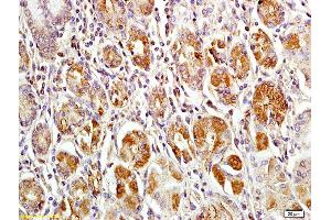 Formalin-fixed and paraffin embedded human gastric carcinoma labeled with Anti-MACC1 Polyclonal Antibody, Unconjugated (ABIN706526) at 1:200 followed by conjugation to the secondary antibody and DAB staining