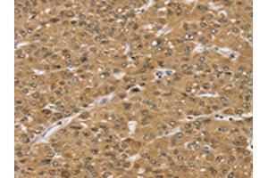 The image on the left is immunohistochemistry of paraffin-embedded Human liver cancer tissue using ABIN7192565(SMC6 Antibody) at dilution 1/30, on the right is treated with synthetic peptide. (SMC6 抗体)
