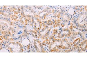Immunohistochemistry of paraffin-embedded Human thyroid cancer tissue using MAP3K12 Polyclonal Antibody at dilution 1:30 (MAP3K12 抗体)