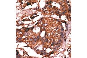 Formalin-fixed and paraffin-embedded human cancer tissue reacted with the primary antibody, which was peroxidase-conjugated to the secondary antibody, followed by AEC staining. (GUCY1A1 抗体  (N-Term))
