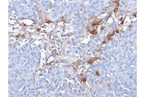 Formalin-fixed, paraffin-embedded human melanoma stained with CD146 antibody (MUC18/1130) (MCAM 抗体)
