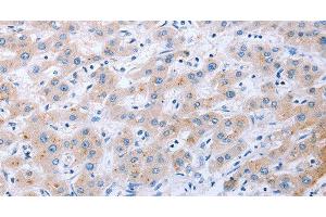 Immunohistochemistry of paraffin-embedded Human liver cancer tissue using FGF4 Polyclonal Antibody at dilution 1:40 (FGF4 抗体)