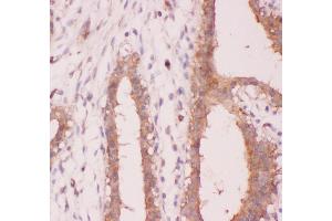 Anti-NFkB p100 Picoband antibody,  IHC(P): Human Mammary Cancer Tissue