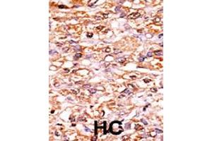 Formalin-fixed and paraffin-embedded human hepatocellular carcinoma tissue reacted with CDKN1B (phospho S178) polyclonal antibody  which was peroxidase-conjugated to the secondary antibody followed by AEC staining. (CDKN1B 抗体  (pSer178))