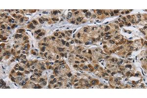 Immunohistochemistry of paraffin-embedded Human liver cancer using HNRNP L Polyclonal Antibody at dilution of 1:40 (HNRNPL 抗体)