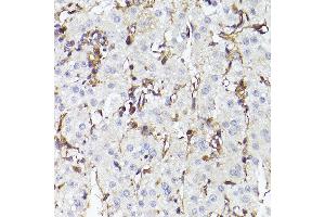 Immunohistochemistry of paraffin-embedded human liver cancer using TLR8 Rabbit pAb (ABIN3022014, ABIN3022015, ABIN3022016, ABIN1513616 and ABIN6218568) at dilution of 1:150 (40x lens). (TLR8 抗体  (AA 849-1041))