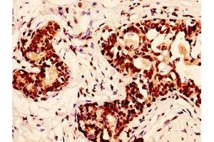 IHC image of nphHU diluted at 1:50 and staining in paraffin-embedded human breast cancer performed on a Leica BondTM system. (H2AFX 抗体)