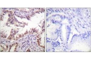 Immunohistochemistry analysis of paraffin-embedded human lung carcinoma tissue, using Histone H3 (Ab-14) Antibody. (Histone 3 抗体  (AA 6-55))