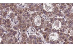 ABIN6273876 at 1/100 staining Human liver cancer tissue by IHC-P. (FFAR2 抗体  (C-Term))