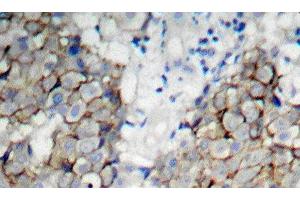 Immunohistochemistry of paraffin-embedded Human breast carcinoma using Phospho-IGF1R(Y1161) Polyclonal Antibody (IGF1R 抗体  (pTyr1161))
