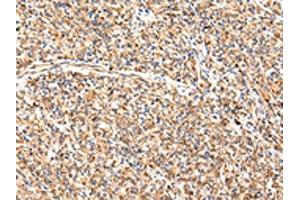 The image on the left is immunohistochemistry of paraffin-embedded Human prostate cancer tissue using ABIN7189649(ADAMTS1 Antibody) at dilution 1/35, on the right is treated with synthetic peptide. (ADAMTS1 抗体)