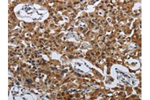 The image on the left is immunohistochemistry of paraffin-embedded Human lung cancer tissue using ABIN7192614(SPAG4 Antibody) at dilution 1/50, on the right is treated with synthetic peptide. (SPAG4 抗体)