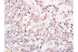 Formalin-fixed and paraffin embedded human cervical carcinoma labeled with Anti-MMP-23 Polyclonal Antibody, Unconjugated (ABIN759176) at 1:200 followed by conjugation to the secondary antibody (Matrix Metallopeptidase 23 (MMP23) (AA 281-380) 抗体)