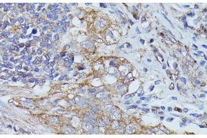 Immunohistochemistry of paraffin-embedded Human lung cancer using CTTN Polyclonal Antibody at dilution of 1:100 (40x lens). (Cortactin 抗体)