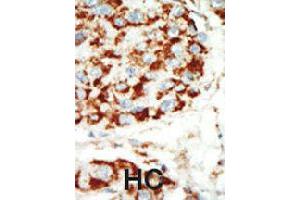 Formalin-fixed and paraffin-embedded human hepatocellular carcinoma tissue reacted with PRKAB1 polyclonal antibody  , which was peroxidase-conjugated to the secondary antibody, followed by AEC staining . (PRKAB1 抗体  (N-Term))