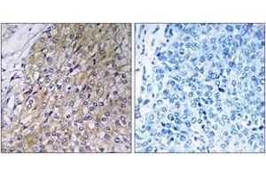 Immunohistochemistry analysis of paraffin-embedded human breast carcinoma tissue, using GOLT1A Antibody.