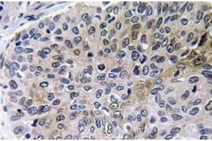 Immunohistochemistry analysis of NGF Antibody in paraffin-embedded human lung carcinoma tissue. (Nerve Growth Factor 抗体)