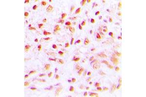 Immunohistochemical analysis of SENP6 staining in human lung cancer formalin fixed paraffin embedded tissue section. (SENP6 抗体  (C-Term))