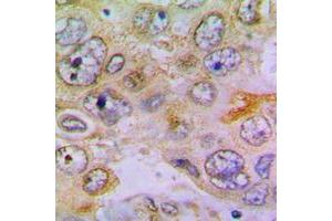 Immunohistochemical analysis of RPL35 staining in human lung cancer formalin fixed paraffin embedded tissue section. (RPL35 抗体  (Center))