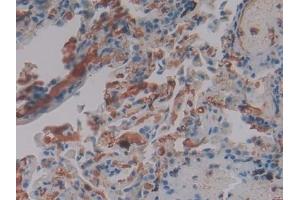 Detection of FGg in Human Lung Tissue using Polyclonal Antibody to Fibrinogen Gamma (FGg) (FGG 抗体  (AA 166-416))