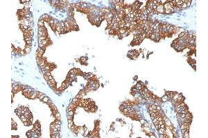 Formalin-fixed, paraffin-embedded human Prostate Carcinoma stained with Cytokeratin 8/18 Monoclonal Antibody (5D3). (CK8 & CK18 抗体)