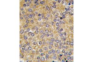 Formalin-fixed and paraffin-embedded human prostata carcinoma tissue reacted with PLAU antibody (N-term), which was peroxidase-conjugated to the secondary antibody, followed by DAB staining. (PLAU 抗体  (N-Term))