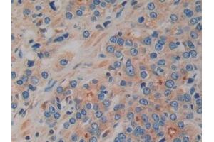 Detection of PK2 in Human Prostate cancer Tissue using Polyclonal Antibody to Prokineticin 2 (PK2)